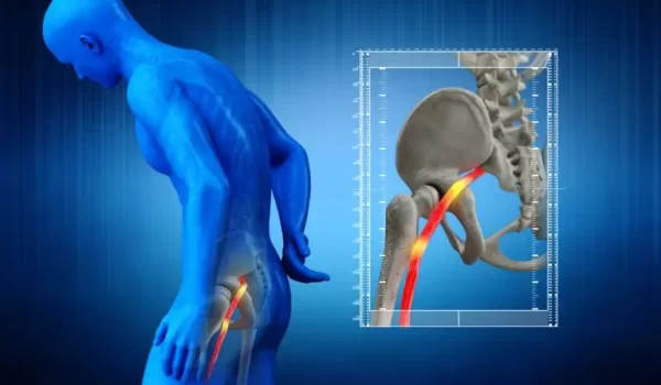 sciatic-nerve-illustration-1-768x512